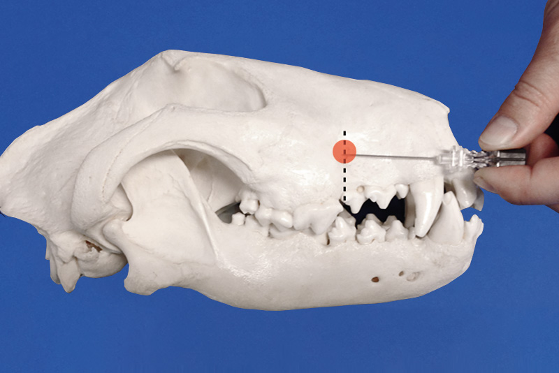 bloqueo del nervio infraorbitario