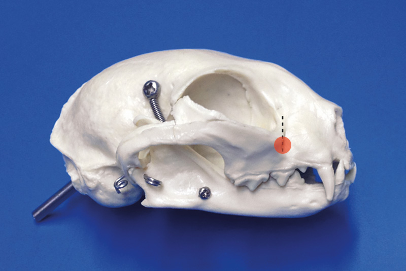 bloqueo del nervio infraorbitario