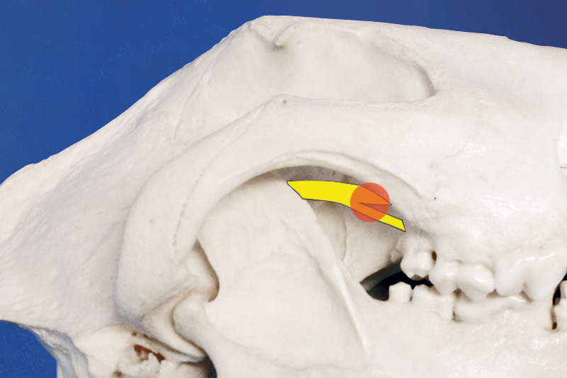 bloqueo del nervio infraorbitario